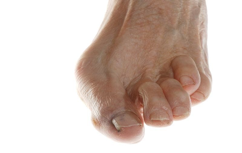What Is a Hammertoe, and How Can It Be Treated?